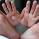 Hand, foot, and mouth disease in a 36-year-old man.